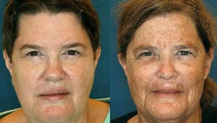 Yüzlerindeki Kırışıklıkların Karşılaştırıldığı İkizlerden Hangilerinin Sigara İçtiğini Kestirim Edebilir misin?