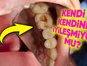 Bedenimizin Rastgele Bir Yeri Kendi Kendini İyileştirebiliyorken Dişlerimiz İçin Neden Bir Müdahale Gerekiyor?