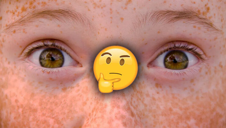 Çiller Nasıl Oluşuyor, Niçin Her Beşerde Olmuyor?