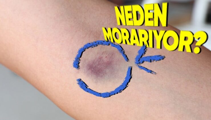 Bilimin Penceresinden Cevaplıyoruz: Kan Verdikten Sonra Kolumuz Neden Morarıyor?